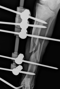 External fixator frame placed on a very fragmented tibial fracture