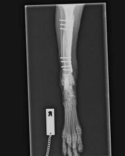 Bone plating of a fractured tibia