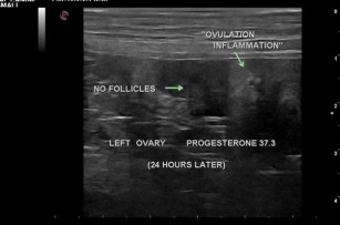 Figure 2: Ultrasound image of the ovary after ovulation has occurred. Note the lack of a round black follicle.